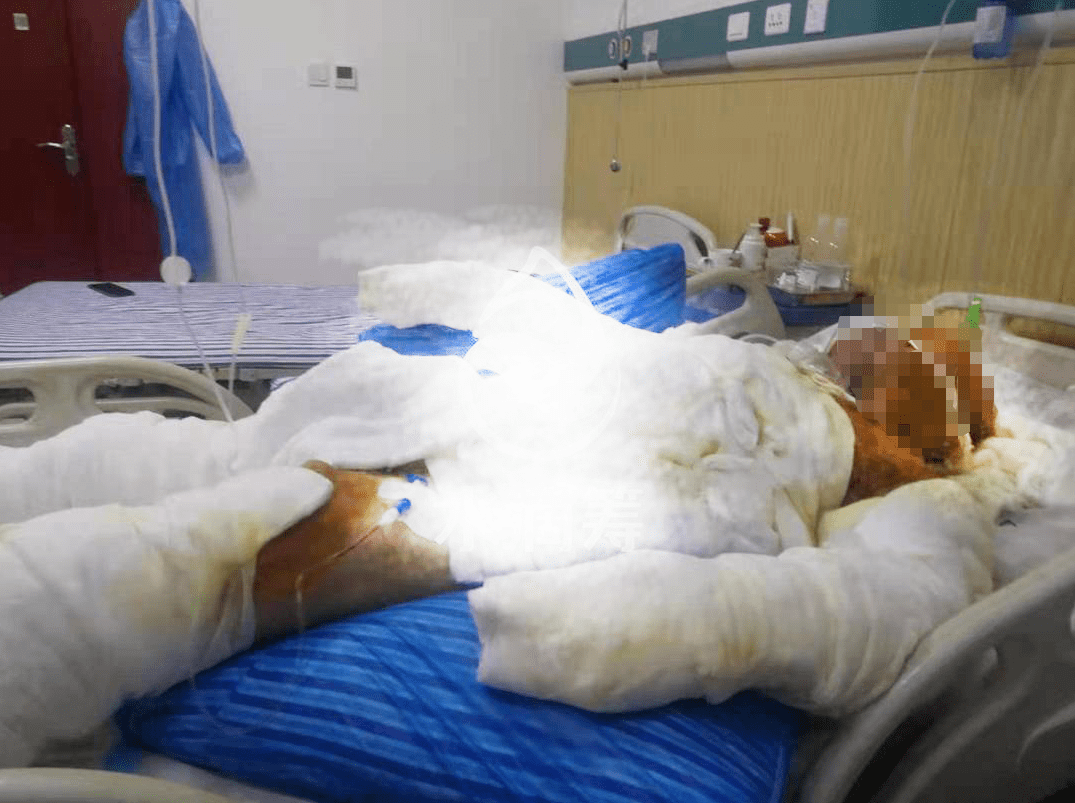 昨日萍鄉(xiāng)一住戶家中發(fā)生煤氣爆炸，全身90%燒傷