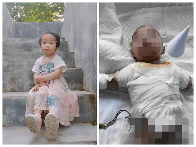 這個(gè)2歲的女孩被燒得面目全非，她的父親很后悔，只因一個(gè)小小的錯(cuò)誤